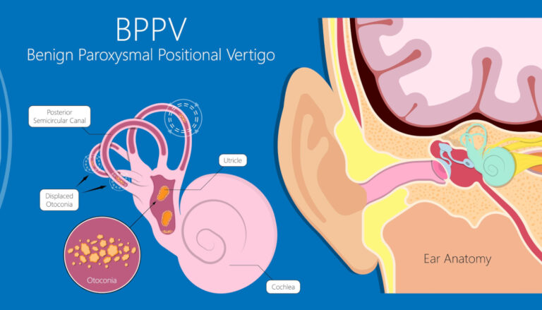 BPPV - Advanced Vestibular Clinics